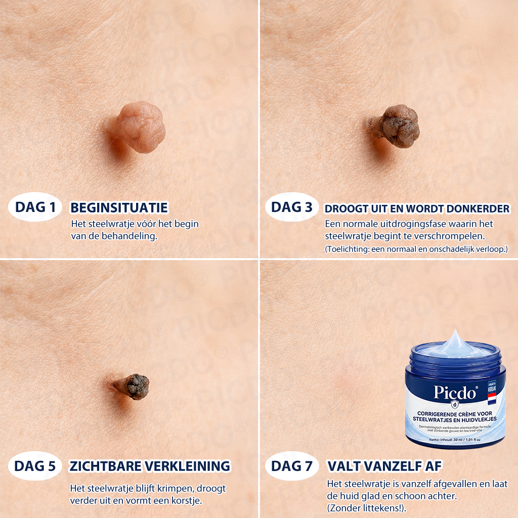 𝐏𝐢𝐜𝐝𝐨® 𝟕-𝐃𝐚𝐠𝐞𝐧 𝐇𝐮𝐢𝐝𝐥𝐢𝐩𝐣𝐞𝐬- & 𝐕𝐥𝐞𝐤𝐤𝐞𝐧𝐯𝐞𝐫𝐰𝐢𝐣𝐝𝐞𝐫𝐢𝐧𝐠𝐬𝐜𝐫è𝐦𝐞 (Pijnloze Formule – Zonder Littekens)🌹