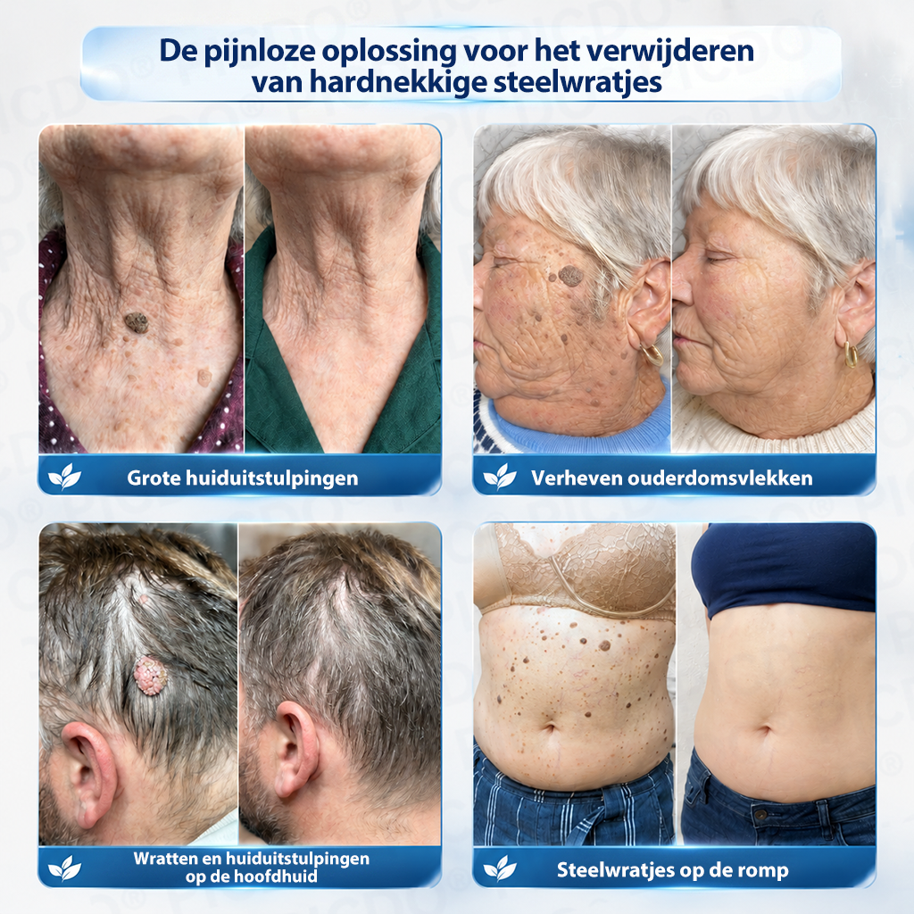𝐏𝐢𝐜𝐝𝐨® 𝟕-𝐃𝐚𝐠𝐞𝐧 𝐇𝐮𝐢𝐝𝐥𝐢𝐩𝐣𝐞𝐬- & 𝐕𝐥𝐞𝐤𝐤𝐞𝐧𝐯𝐞𝐫𝐰𝐢𝐣𝐝𝐞𝐫𝐢𝐧𝐠𝐬𝐜𝐫è𝐦𝐞 (Pijnloze Formule – Zonder Littekens)🌹