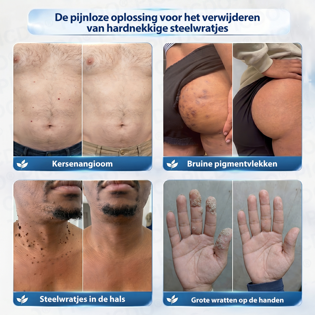 𝐏𝐢𝐜𝐝𝐨® 𝟕-𝐃𝐚𝐠𝐞𝐧 𝐇𝐮𝐢𝐝𝐥𝐢𝐩𝐣𝐞𝐬- & 𝐕𝐥𝐞𝐤𝐤𝐞𝐧𝐯𝐞𝐫𝐰𝐢𝐣𝐝𝐞𝐫𝐢𝐧𝐠𝐬𝐜𝐫è𝐦𝐞 (Pijnloze Formule – Zonder Littekens)🌹