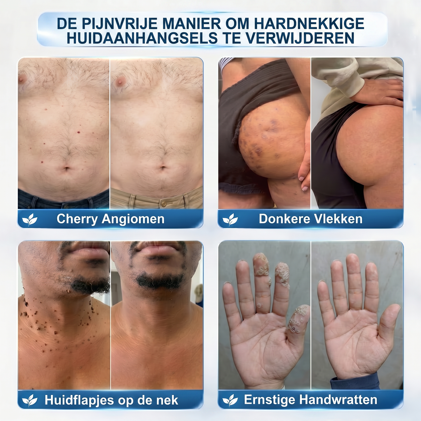 Officiële merk winkel |🔥𝐏i𝐜𝐝o® 7-DAGEN Wratten & Plekjes Verwijderaar (Pijnloos, littekenvrij rollerbal-applicator)💎