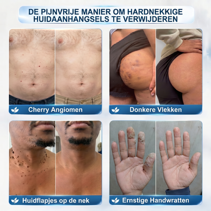 Officiële merk winkel |🔥𝐏i𝐜𝐝o® 7-DAGEN Wratten & Plekjes Verwijderaar (Pijnloos, littekenvrij rollerbal-applicator)💎