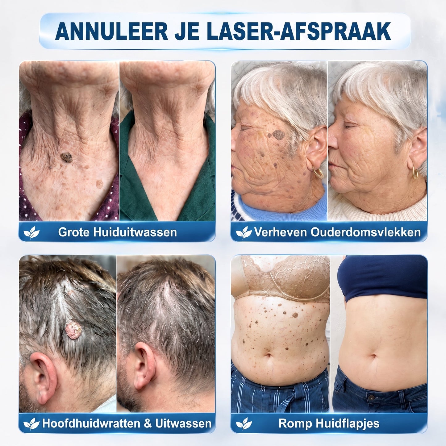 Officiële merk winkel |🔥𝐏i𝐜𝐝o® 7-DAGEN Wratten & Plekjes Verwijderaar (Pijnloos, littekenvrij rollerbal-applicator)💎