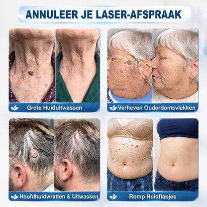 Officiële merk winkel |🔥𝐏i𝐜𝐝o® 7-DAGEN Wratten & Plekjes Verwijderaar (Pijnloos, littekenvrij rollerbal-applicator)💎