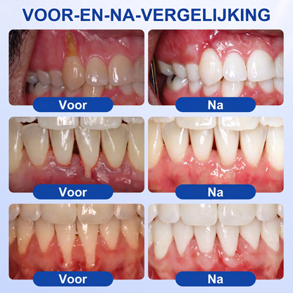 Glimmerly® 🎋🌳GUMREVIVE PERIODONTAAL REPARATIEGEL