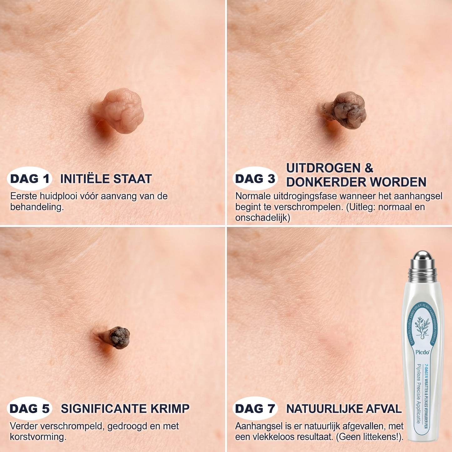 Officiële merk winkel |🔥𝐏i𝐜𝐝o® 7-DAGEN Wratten & Plekjes Verwijderaar (Pijnloos, littekenvrij rollerbal-applicator)💎