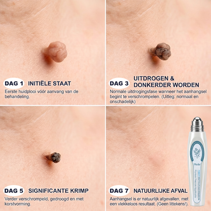 Officiële merk winkel |🔥𝐏i𝐜𝐝o® 7-DAGEN Wratten & Plekjes Verwijderaar (Pijnloos, littekenvrij rollerbal-applicator)💎