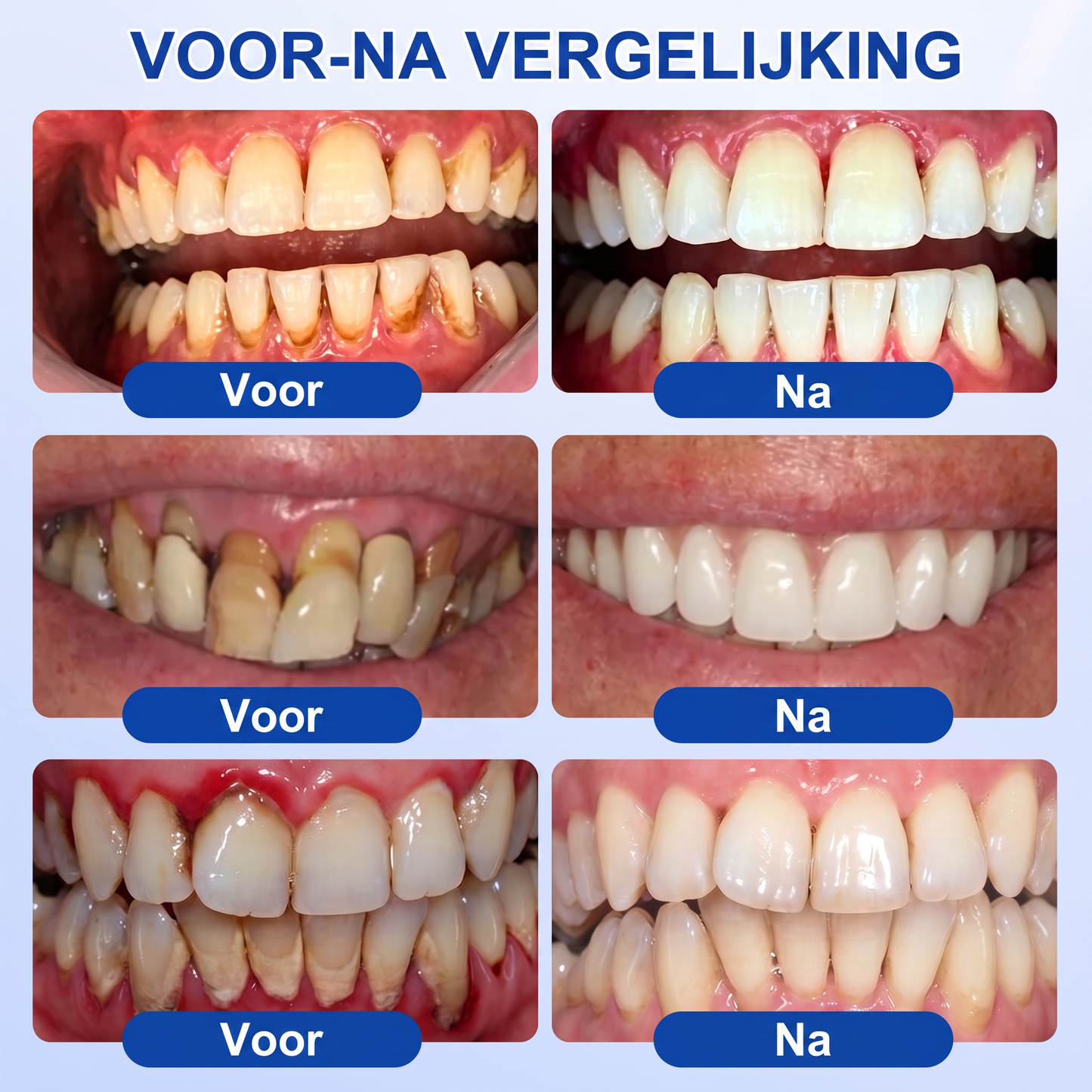 Glimmerly® 🎋🌳GUMREVIVE PERIODONTAAL REPARATIEGEL