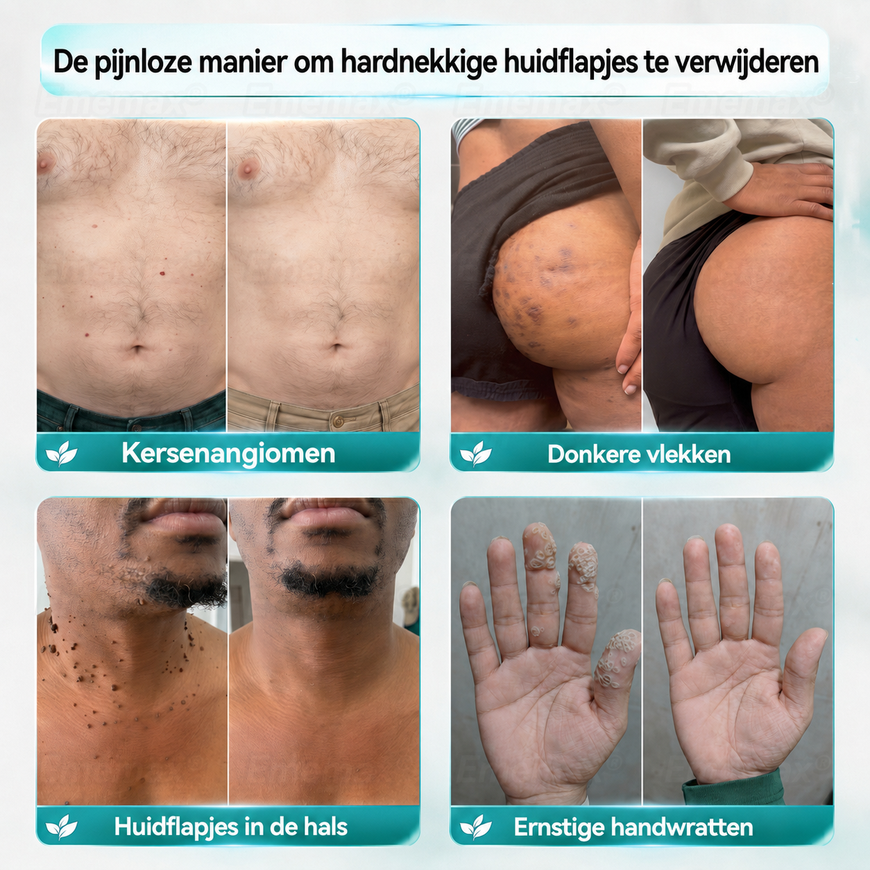 ✨👍𝐄𝐦𝐞𝐦𝐚𝐱®2 𝒊𝒏 1 𝑴𝒊𝒄𝒓𝒐-𝒏𝒂𝒂𝒍𝒅 & 𝑯𝒚𝒅𝒓𝒐𝒄𝒐𝒍𝒍𝒐ï𝒅 𝑴𝒐𝒆𝒅𝒆𝒓𝒗𝒍𝒆𝒌 𝑽𝒆𝒓𝒘𝒊𝒋𝒅𝒆𝒓𝒊𝒏𝒈 𝑷𝒍𝒆𝒊𝒔𝒕𝒆𝒓(𝑃𝑙𝑒𝑖𝑠𝑡𝑒𝑟 𝑧𝑜𝑛𝑑𝑒𝑟 𝑝𝑖𝑗𝑛, 𝑧𝑜𝑛𝑑𝑒𝑟 𝑙𝑖𝑡𝑡𝑒𝑘𝑒𝑛𝑠)