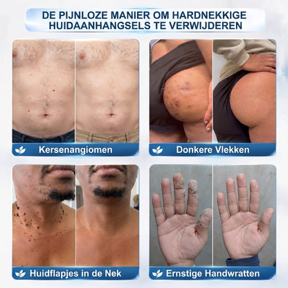👩‍⚕️🥇 𝑂𝑓𝑓𝑖𝑐𝑖ë𝑙𝑒 𝑊𝑖𝑛𝑘𝑒𝑙 | 𝑵𝐞𝒌𝐢𝐬𝐬®  𝑴𝒊𝒄𝒓𝒐𝒏𝒂𝒂𝒍𝒅 𝑽𝒍𝒆𝒌𝒌𝒆𝒍𝒐𝒛𝒆 𝑯𝒖𝒊𝒅 𝑾𝒓𝒂𝒕𝒕𝒆𝒏 𝑽𝒆𝒓𝒘𝒊𝒋𝒅𝒆𝒓𝒆𝒏 𝑷𝒍𝒆𝒊𝒔𝒕𝒆𝒓 (𝑉𝑜𝑜𝑟 ℎ𝑢𝑖𝑑𝑓𝑙𝑎𝑝𝑗𝑒𝑠, 𝑘𝑙𝑒𝑖𝑛𝑒 ℎ𝑢𝑖𝑑𝑔𝑟𝑜𝑒𝑖𝑠𝑒𝑙𝑠, 𝑤𝑟𝑎𝑡𝑡𝑒𝑛, 𝑚𝑜𝑒𝑑𝑒𝑟𝑣𝑙𝑒𝑘𝑘𝑒𝑛, 𝑜𝑢𝑑𝑒𝑟𝑑𝑜𝑚𝑠𝑣𝑙𝑒𝑘𝑘𝑒𝑛 𝑒𝑛 𝑝𝑖𝑔𝑚𝑒𝑛𝑡𝑎𝑡𝑖𝑒𝑝𝑟𝑜𝑏𝑙𝑒𝑚𝑒𝑛)